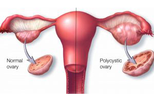 Como-Eliminar-Ovarios-Poliquisticos-300x169